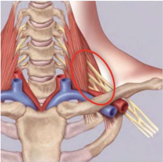 Syndrome du Défilé Thoracobrachial (SDTB)